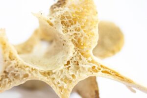 Osteoporosis 