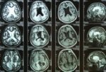 xplaining multiple sclerosis diagnosis and treatment options to an adult patient during a neurological consultati