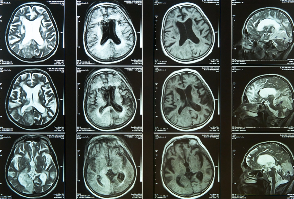 xplaining multiple sclerosis diagnosis and treatment options to an adult patient during a neurological consultati