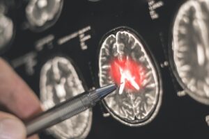 multiple sclerosis diagnosis