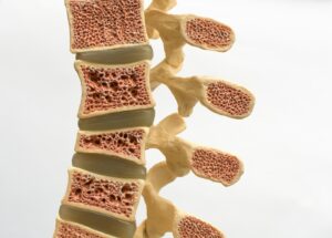 Osteoporosis in the elderly